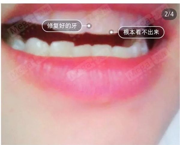 美加贴面这个小薄片,让笑容焕然一新!