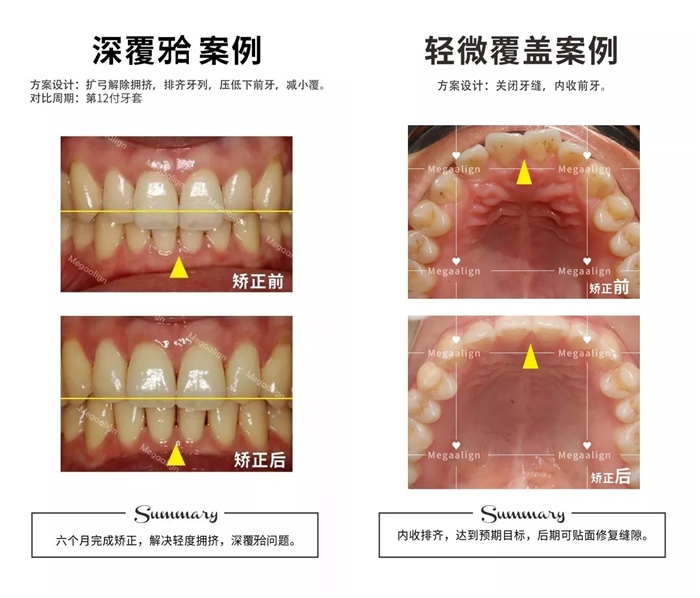 美加易齐隐形矫正深覆合案例