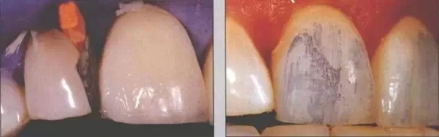 瓷贴面修复后的该如何维护?
