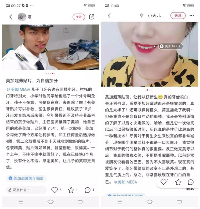 瓷贴面修复后的该如何维护?