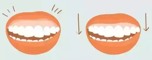 牙龈出轨,露龈笑