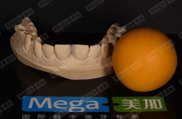 美加瓷贴面案例丨7天关闭牙缝,美加微贴面效果赞