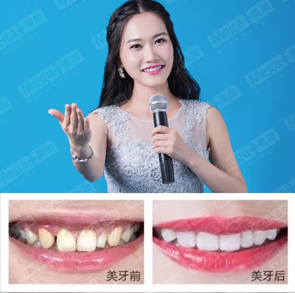 美加贴面案例丨感谢你告诉我,我又美了