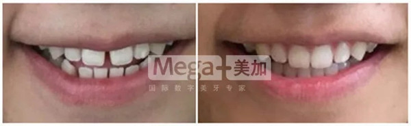有牙缝VS没牙缝