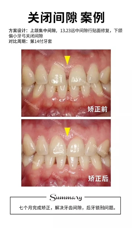 易齐微矫正案例集