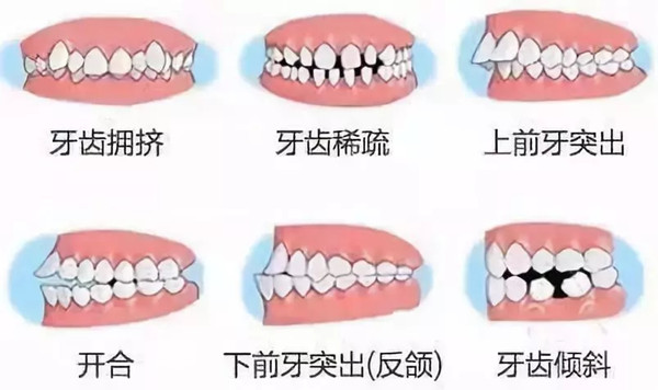牙齿矫正一定要拔牙么,为啥需要拔牙?