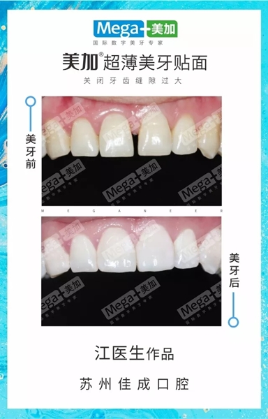 美加超薄美牙贴面案例