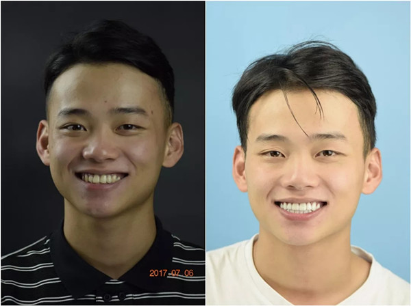 牙齿发黄的他,选择美加牙贴面开启了阳光帅气的自信!