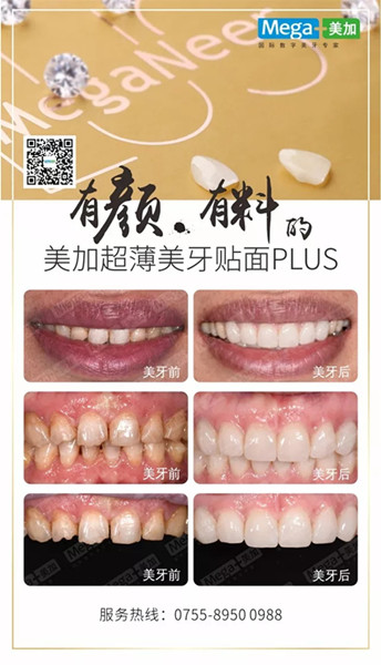 美加贴面plus美牙案例展示,揭秘高端美齿之选
