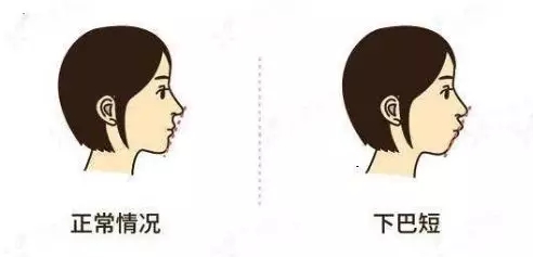 牙齿类型四:深覆合