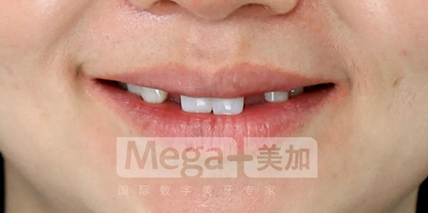 失去牙齿的支撑,笑容不够饱满噢