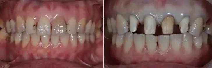 美加美牙贴面案例丨被虫咬了的门牙,跟他一样补,好看!