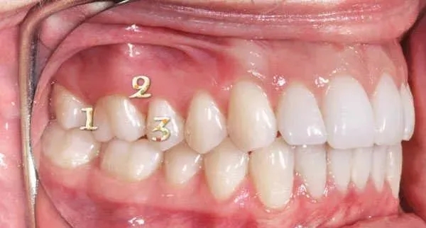 牙齿咬合关系不良