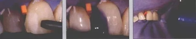 瓷贴面修复后的该如何维护?