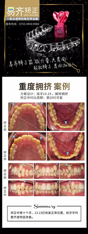 美加易齐透明矫正前后对比案例图