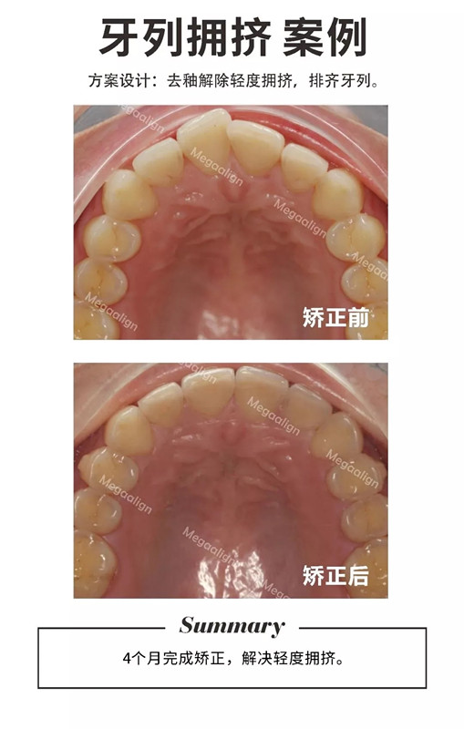 易齐微矫正案例集