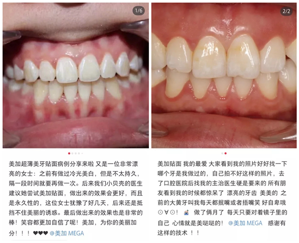小红书上那么多人在用的美加贴面,我该怎么买?