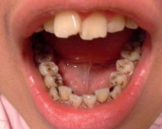 牙齿排列不齐做矫正有必要吗?