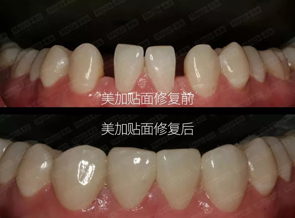 美加案例:瓷贴面关闭缝隙修复过小牙