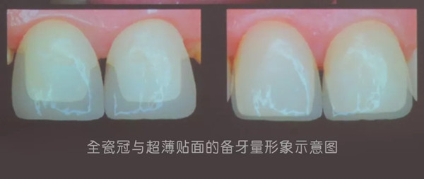 全瓷冠与超薄贴面的备牙量形象示意图