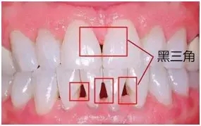 超薄瓷贴面修复黑三角