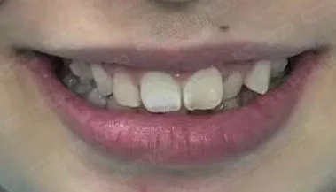 这种牙不齐用易齐矫正也可以排齐!
