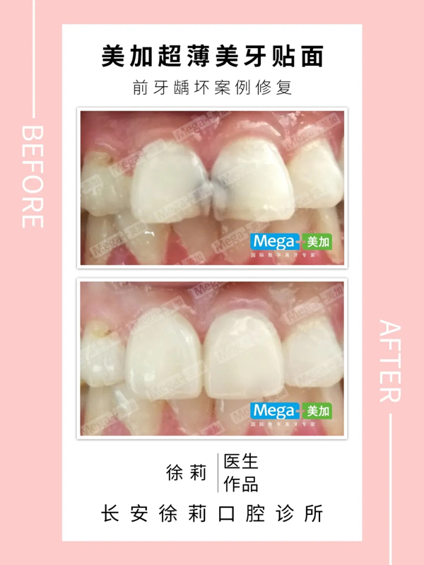 美加贴面前牙龋坏修复