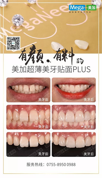 美加贴面plus美牙案例展示,揭秘高端美齿之选
