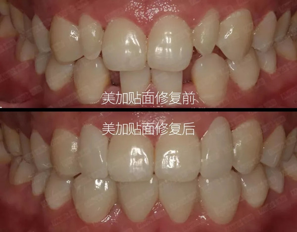 美加案例:瓷贴面关闭缝隙修复过小牙