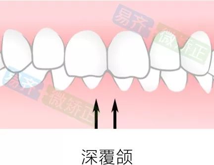 ★ 1mm以内压低 ★
