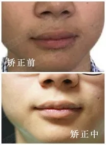 很多人说要先整牙再整容,这是为什么呢?