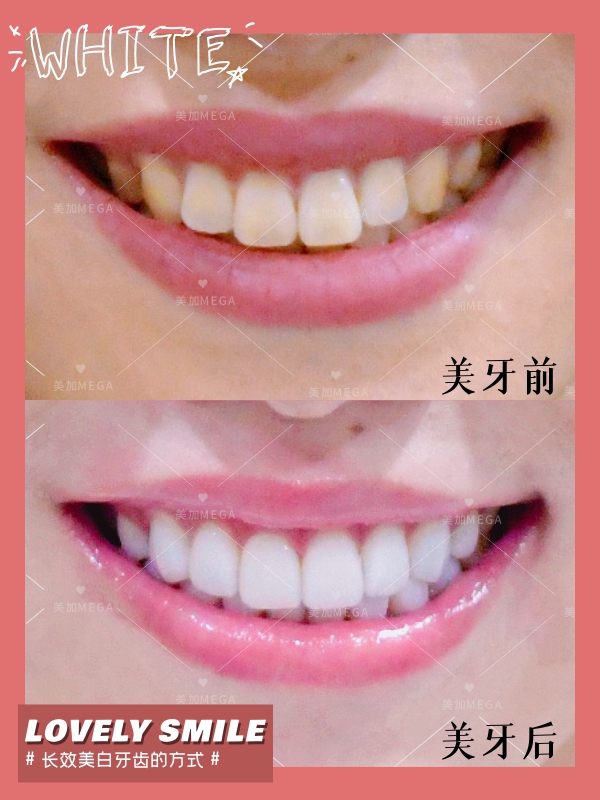 牙齿黄咋办,可以试试瓷贴面提升你的颜值!