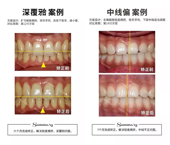 美加易齐微矫案例