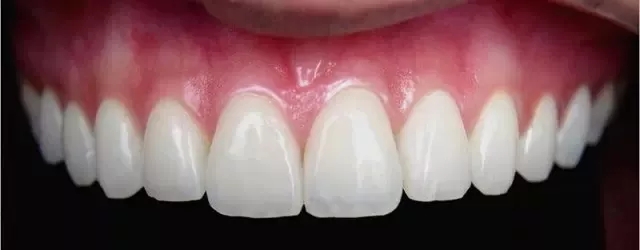 瓷贴面修复后的该如何维护?
