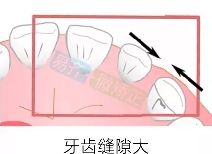 美加易齐微矫的适应症有哪些?