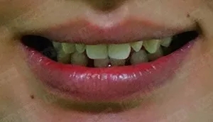 美加贴面案例:瓷贴面修复牙形态不佳