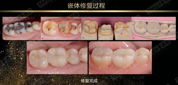 嵌体修复过程