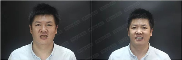 美加牙贴面案例:中重度四环素牙全口美白后,颜值暴涨!