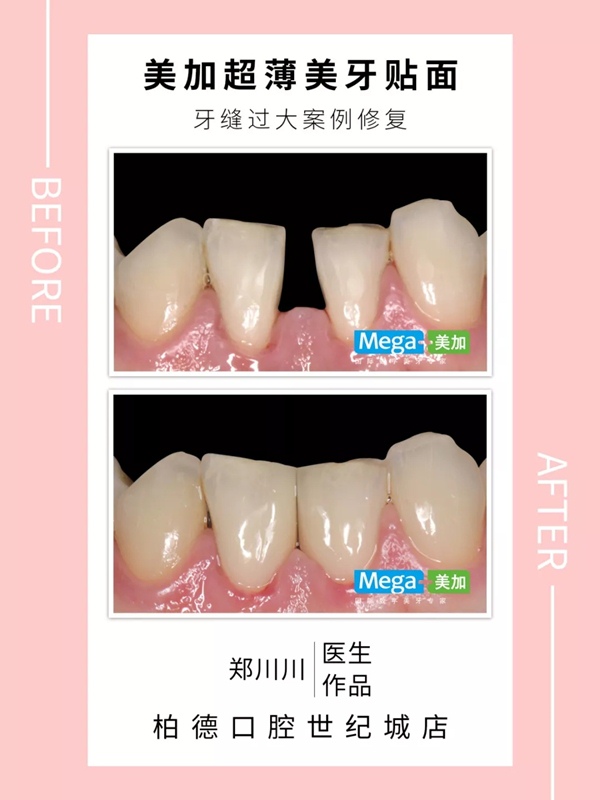 美加超薄美牙贴面牙缝隙大修复案例