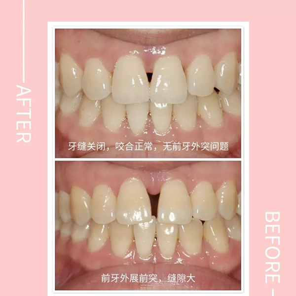▲美加易齐微矫半年解决门牙间隙,说话唱歌再也不漏风啦!