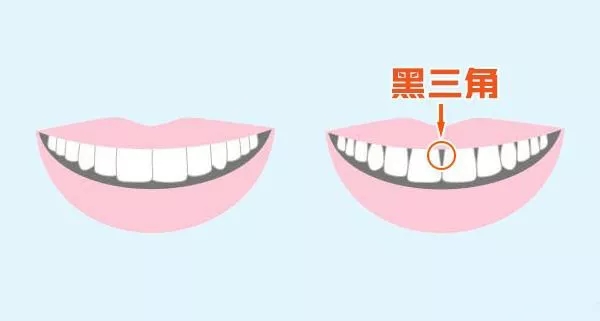 什么是黑三角?