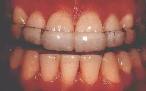 瓷贴面修复后的该如何维护?