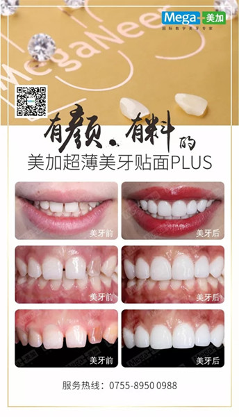 美加贴面plus美牙案例展示,揭秘高端美齿之选