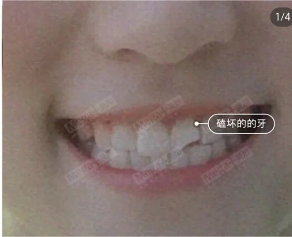 美加贴面这个小薄片,让笑容焕然一新!