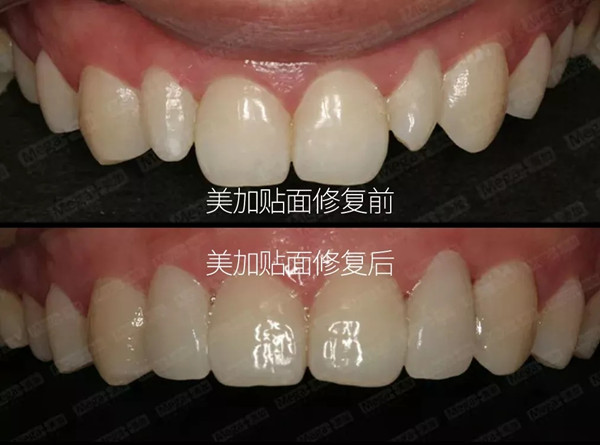 美加案例:瓷贴面关闭缝隙修复过小牙