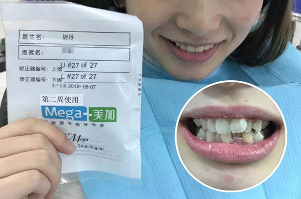 这种牙不齐用易齐矫正也可以排齐!