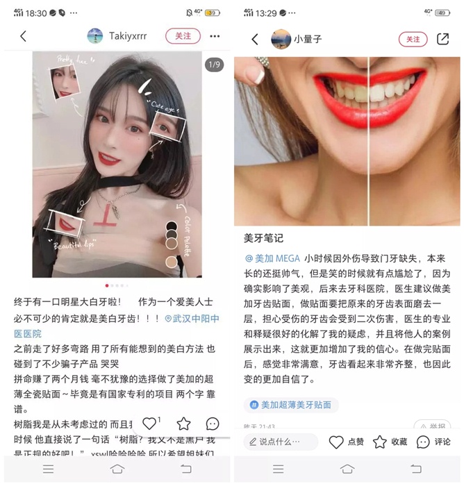 为什么他们都愿意在小红书上种草美加贴面?