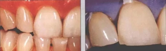 瓷贴面修复后的该如何维护?