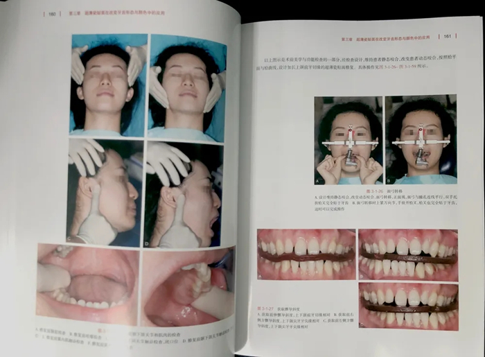 《超薄瓷贴面美学修复》这本贴面宝典你值得拥有!