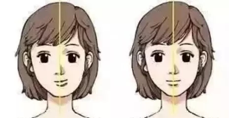 牙齿类型五:偏颌
